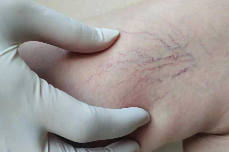 Kaj pomenijo popokane kapilare na nogah ali pajkaste žilice?