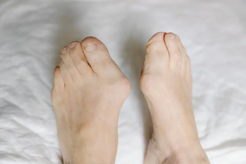 Ukrivljen in boleč palec na nogi (Hallux valgus)